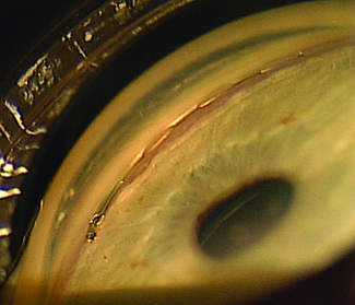 hydrus stent image